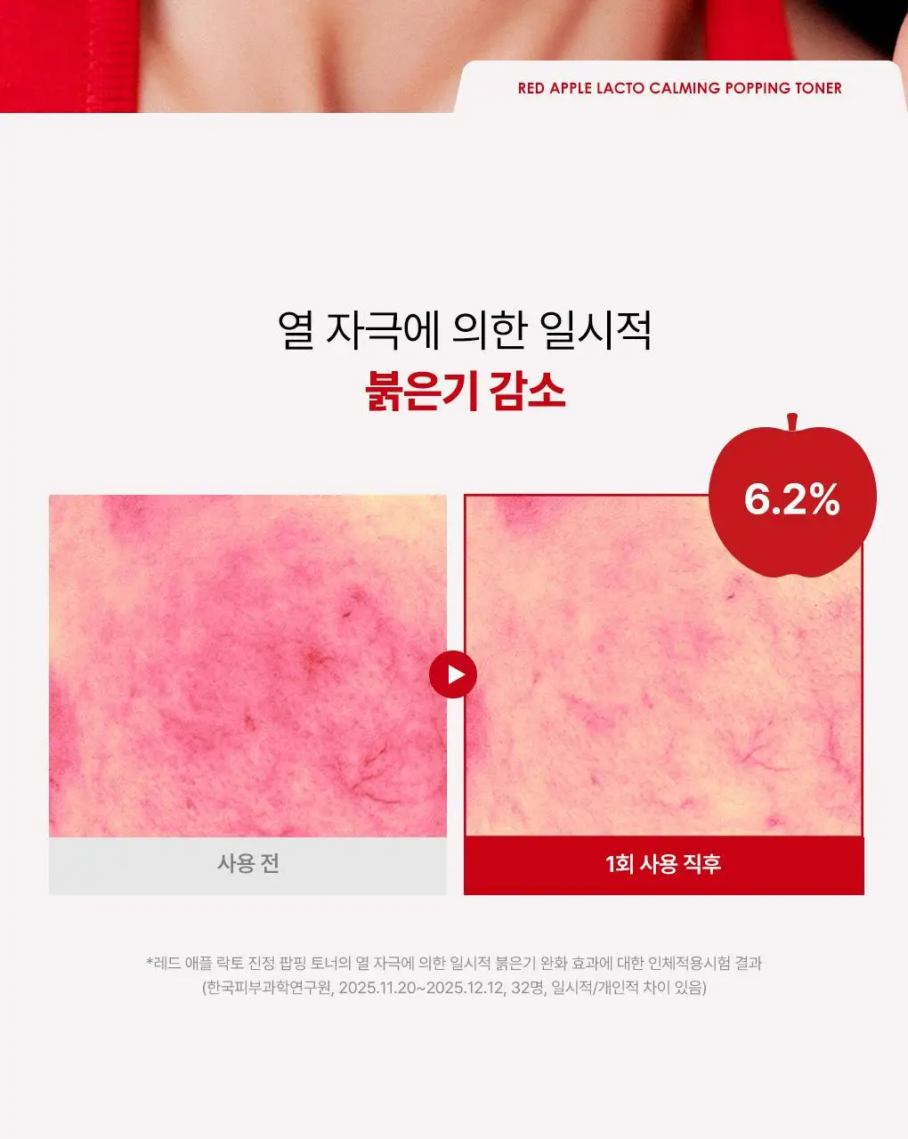 [NEW/단독기획] rdrd 레드 애플 락토 진정 팝핑 토너 95g 응급진정 KIT 기획 상세페이지 14